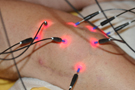 Laserakupunktur am Knie